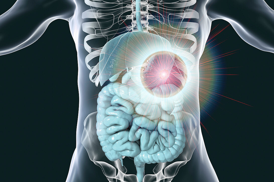 Human stomach cancer treatment, conceptual illustration