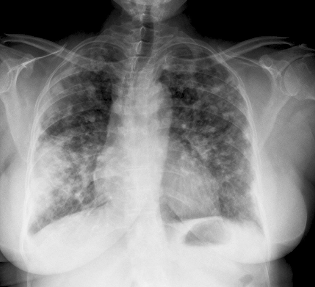 Secondary lung cancer, X-ray