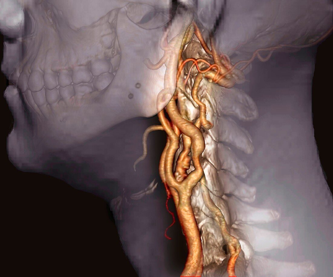 Atherosclerosis in neck arteries, 3D CT scan