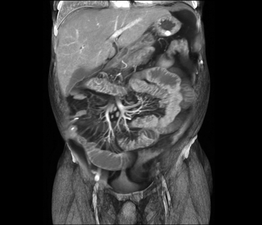 Crohn's disease research, MRI scan