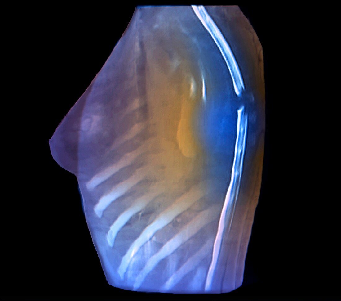 Spinal cord tumour, CT myelography scan