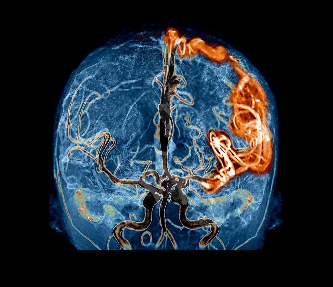 Cerebral arteriovenous malformation, 3D CT scan