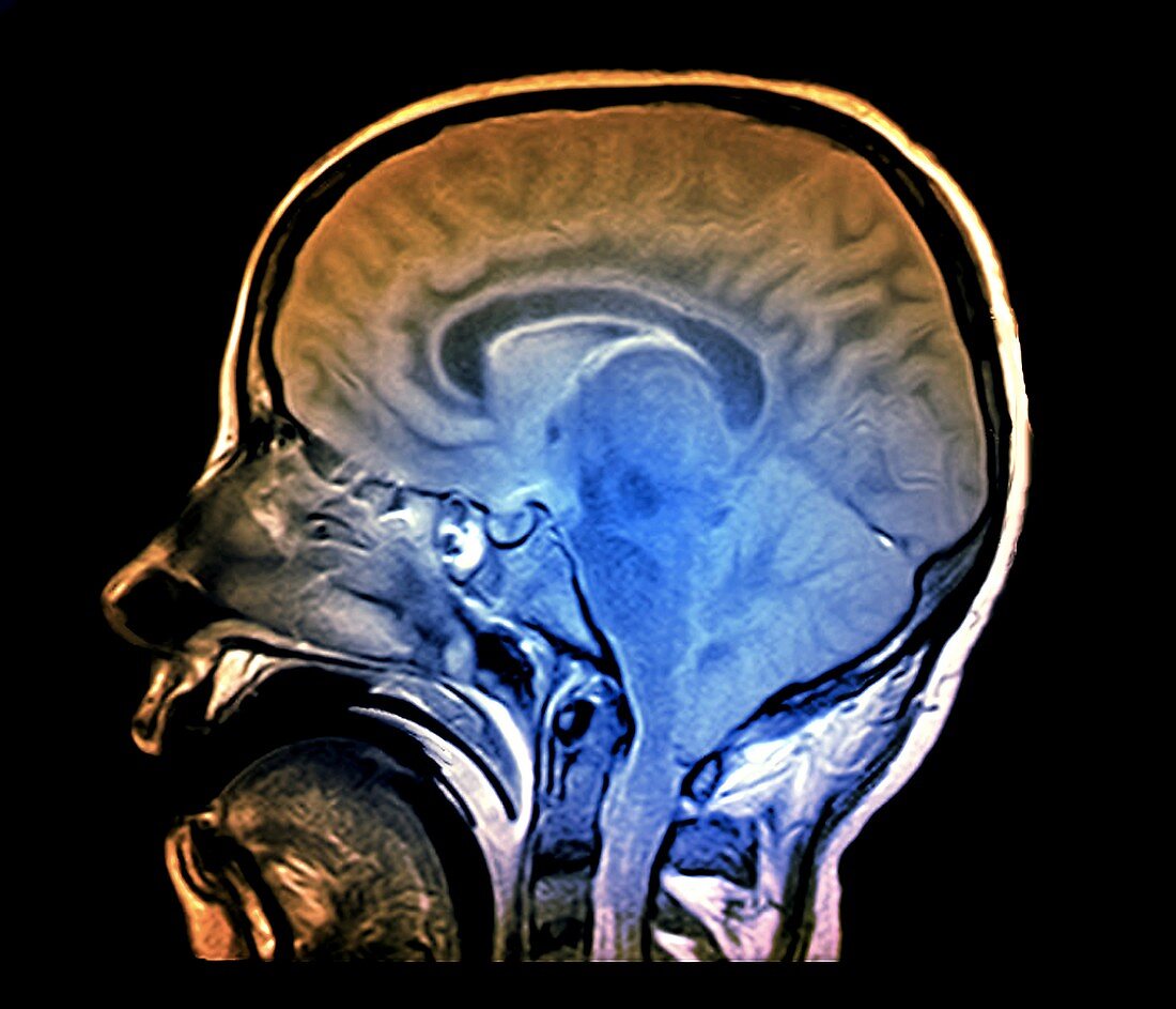 Brain death test, MRI scan