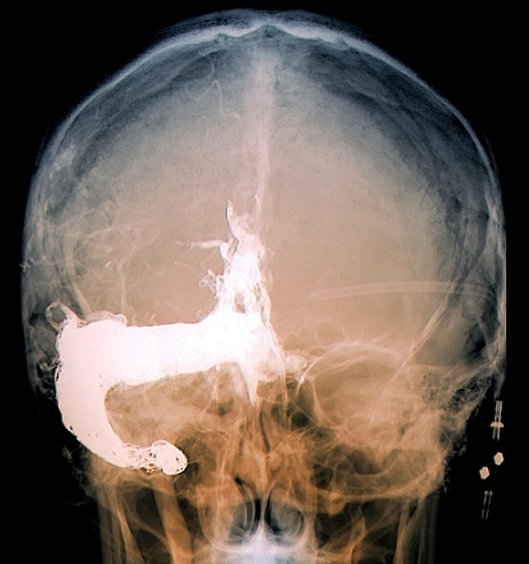 Cerebral arteriovenous malformation treatment, X-ray
