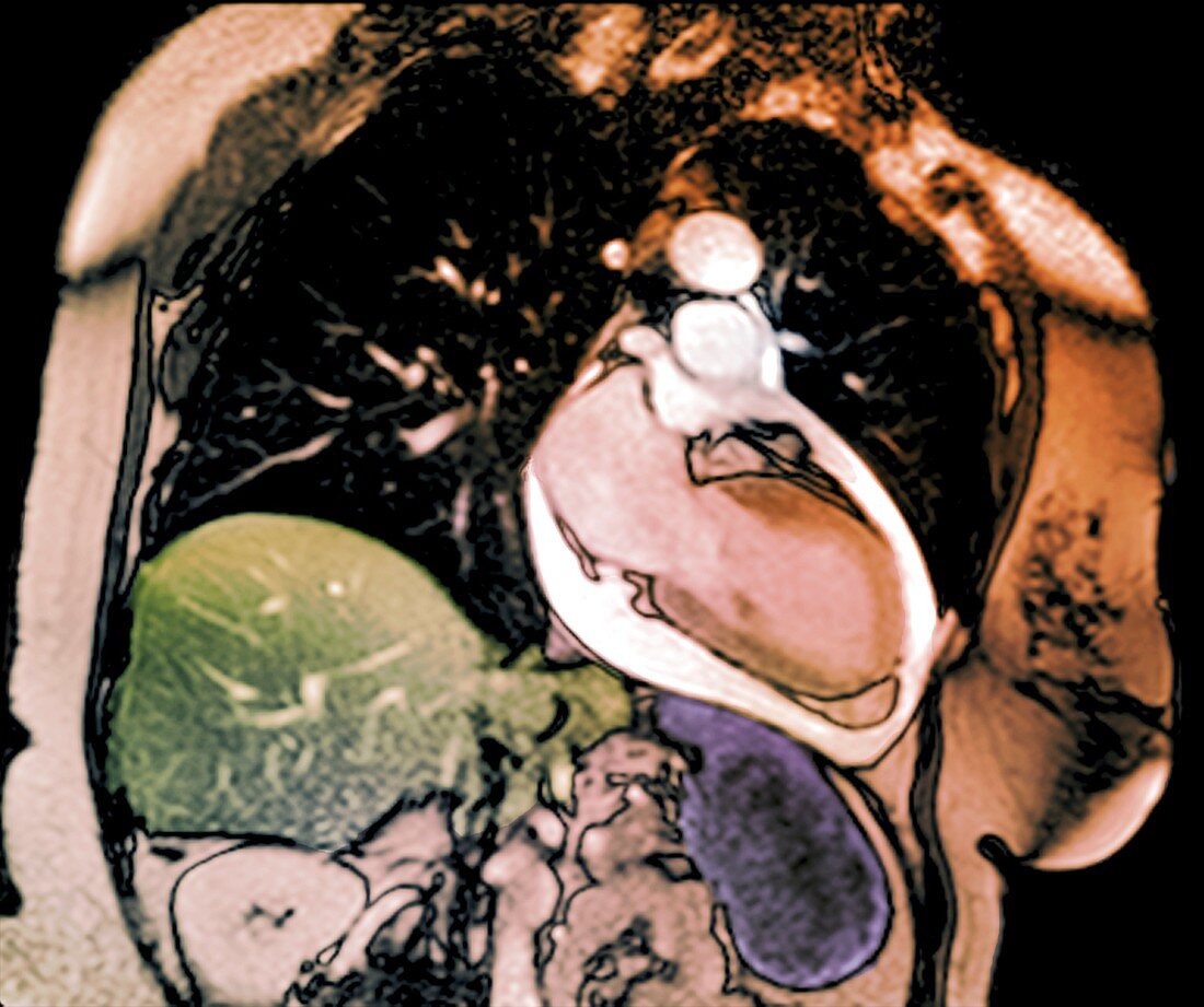 Chronic pericarditis, MRI scan