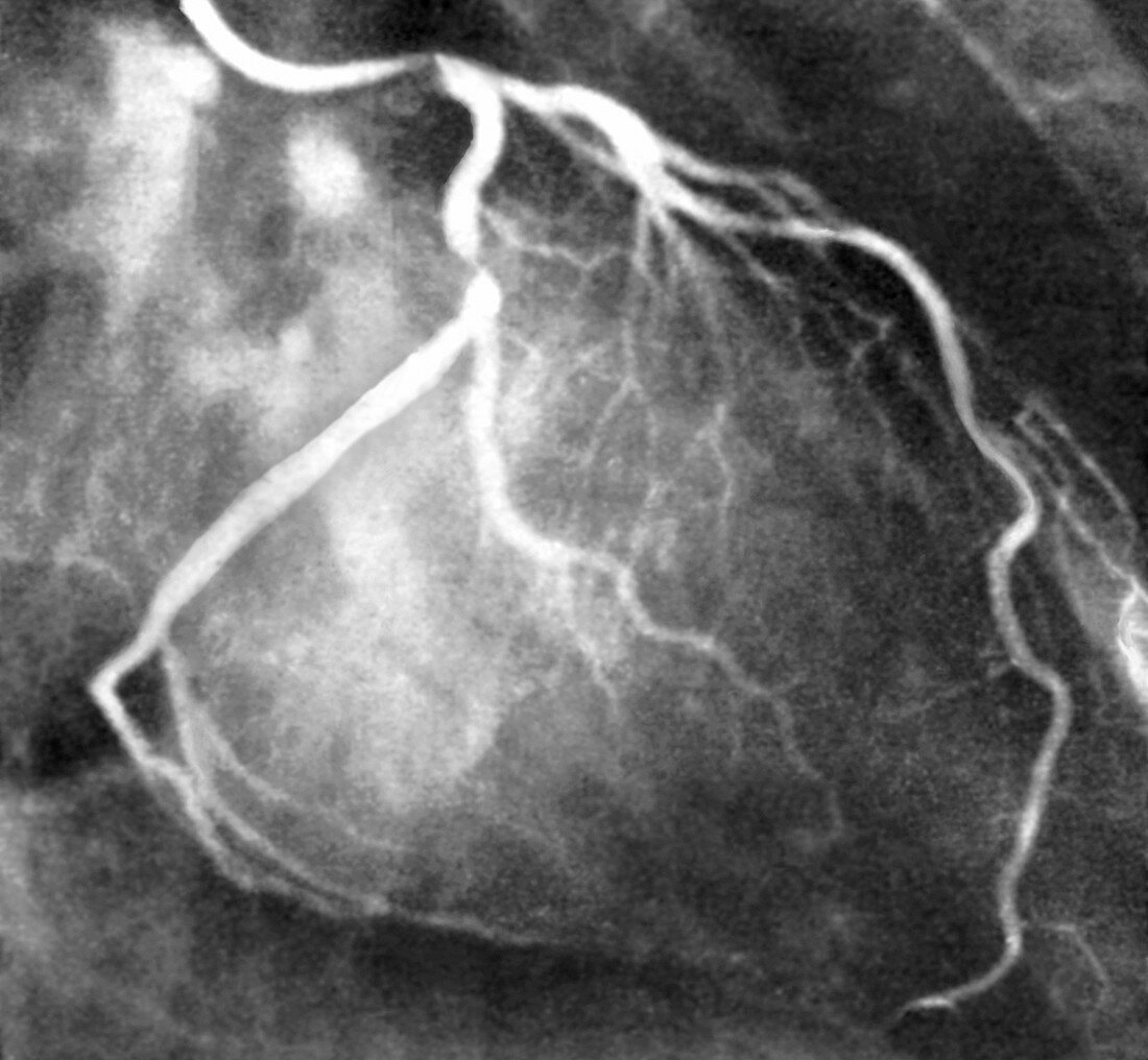 Coronary artery stenosis, coronarography scan