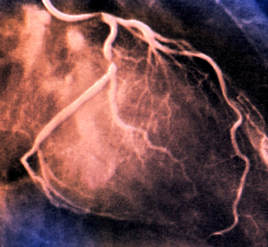 Coronary artery stenosis, coronarography scan