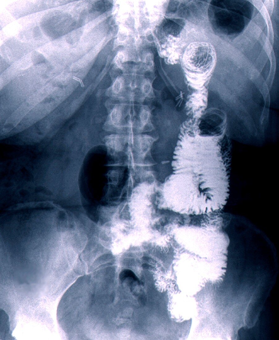 Gastric bypass, X-ray