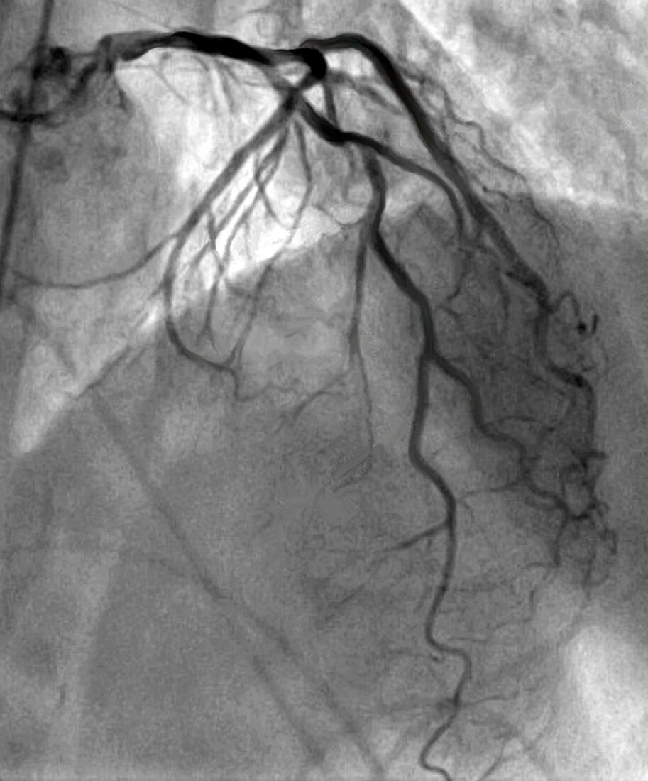 Left coronary artery network, coronarography scan