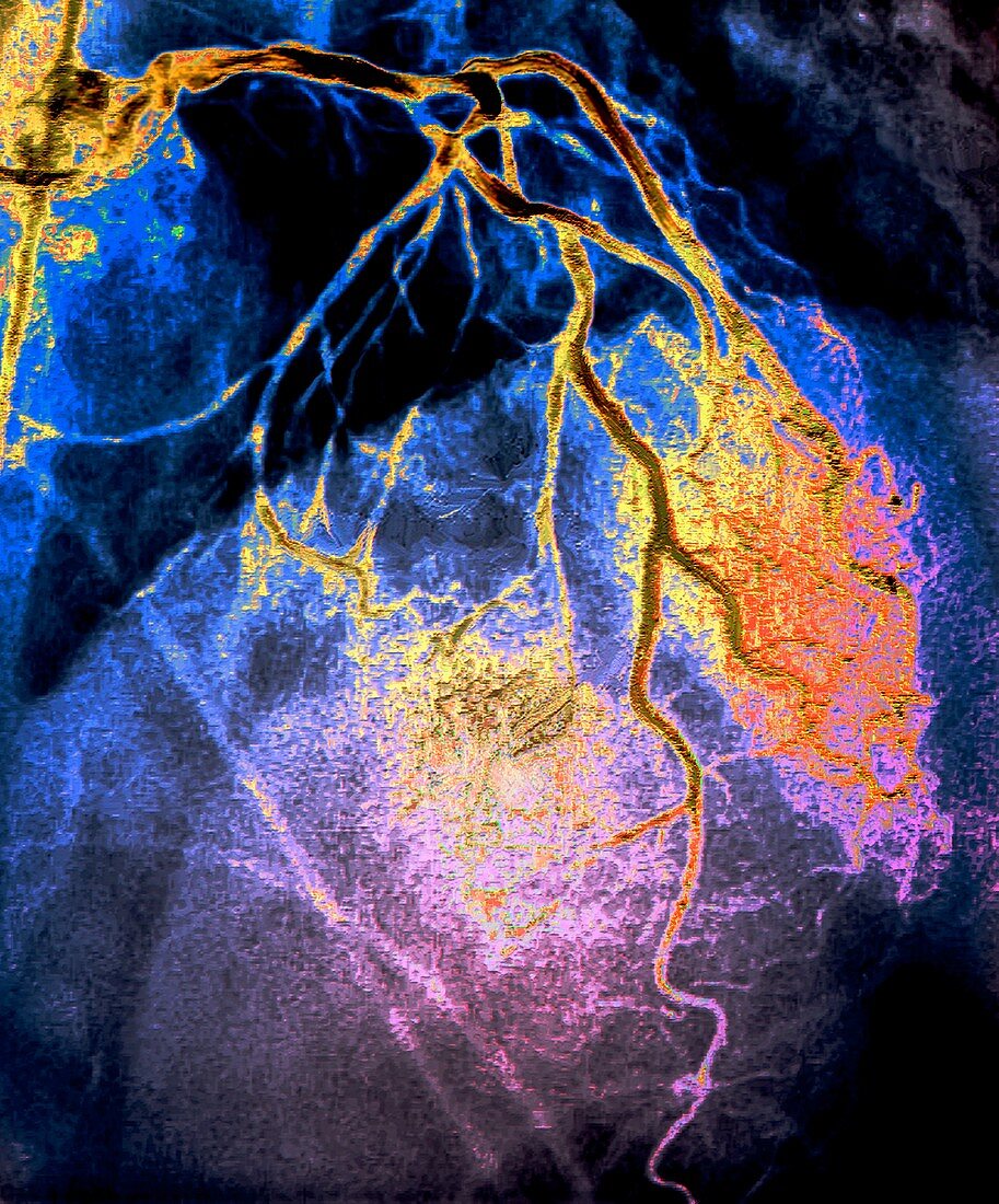 Left coronary artery network, coronarography scan