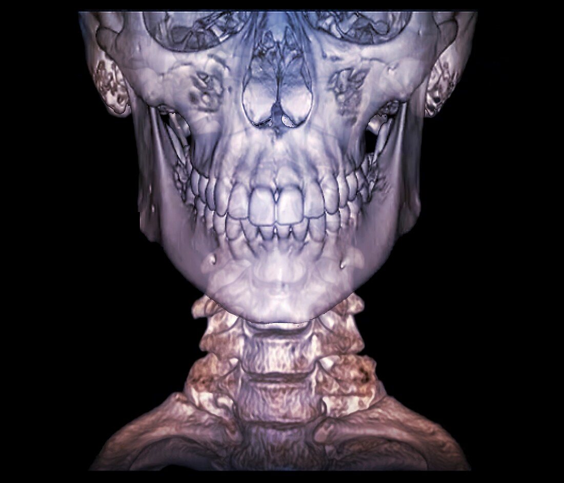 Human skull and cervical spine, 3D CT scan
