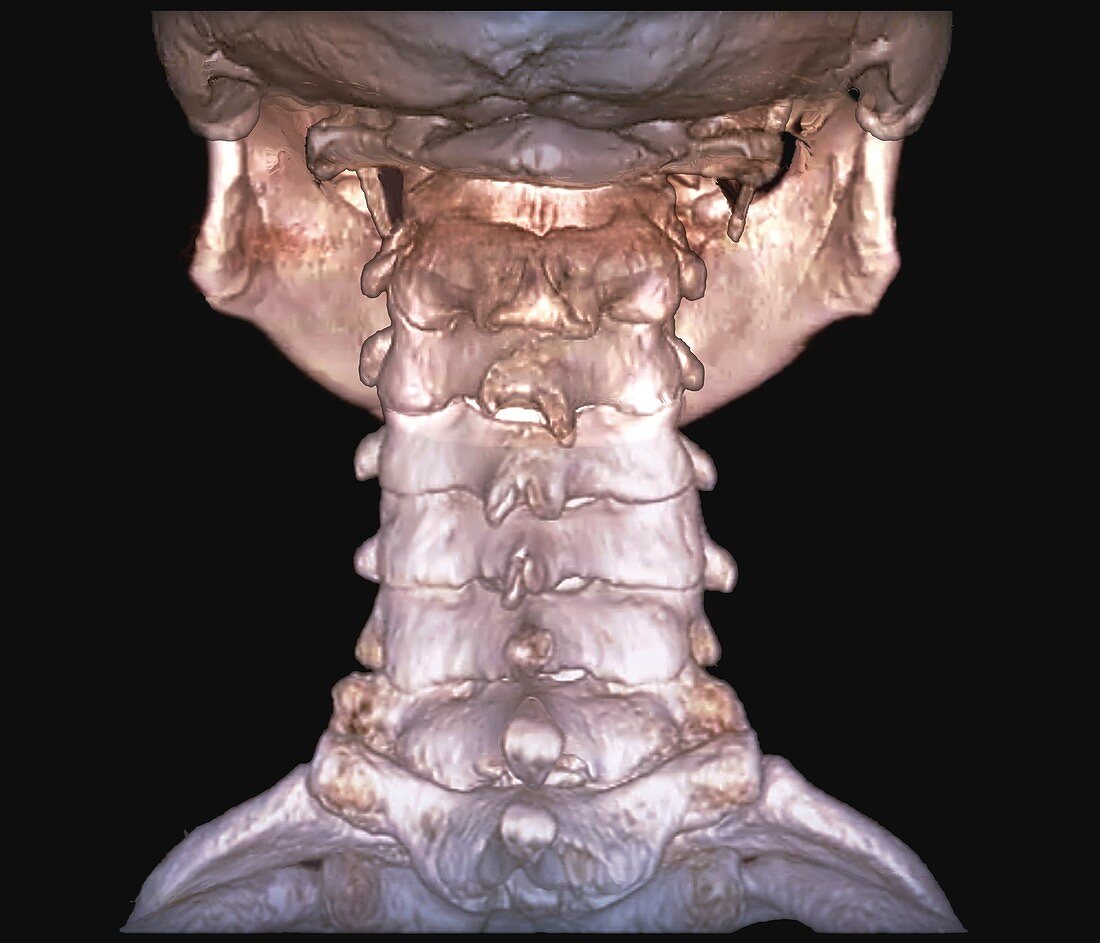 Human cervical spine, 3D CT scan