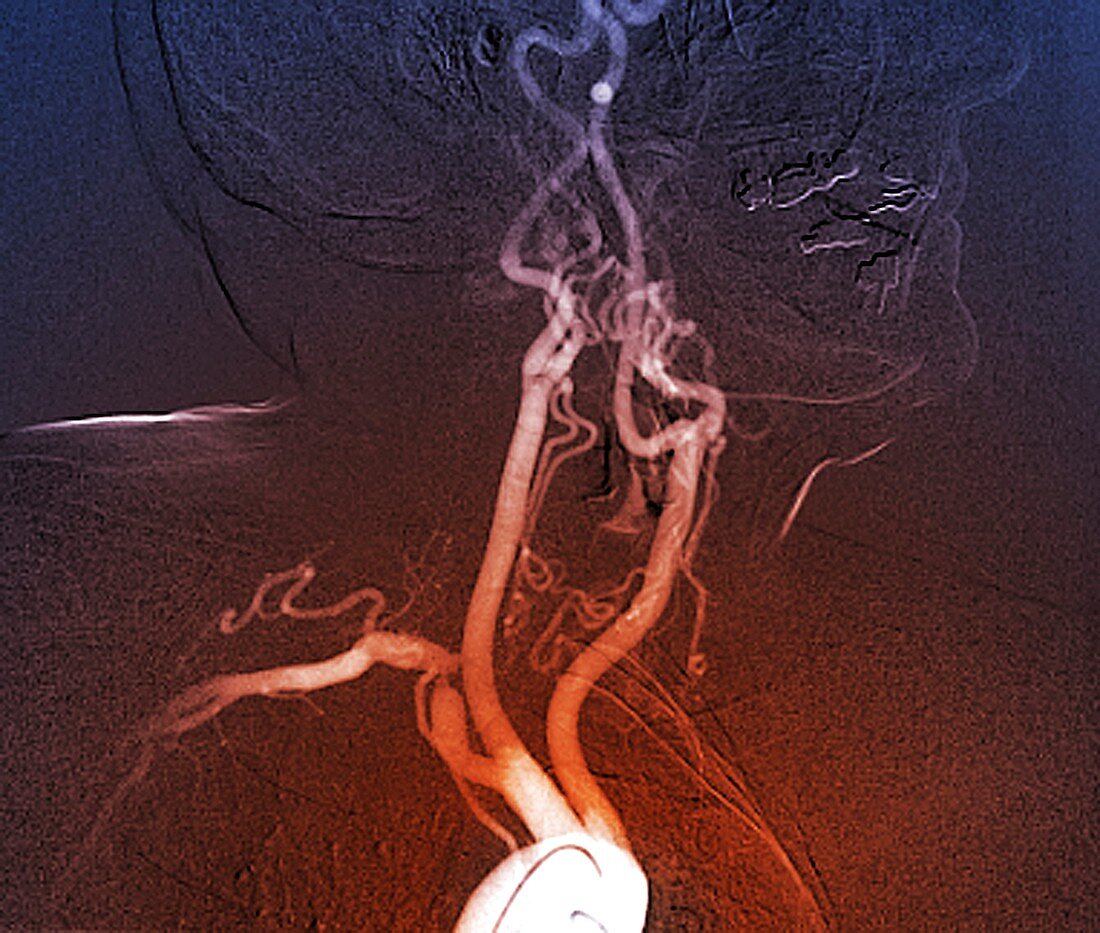 Reduced blood flow in polyvascular disease, angiogram