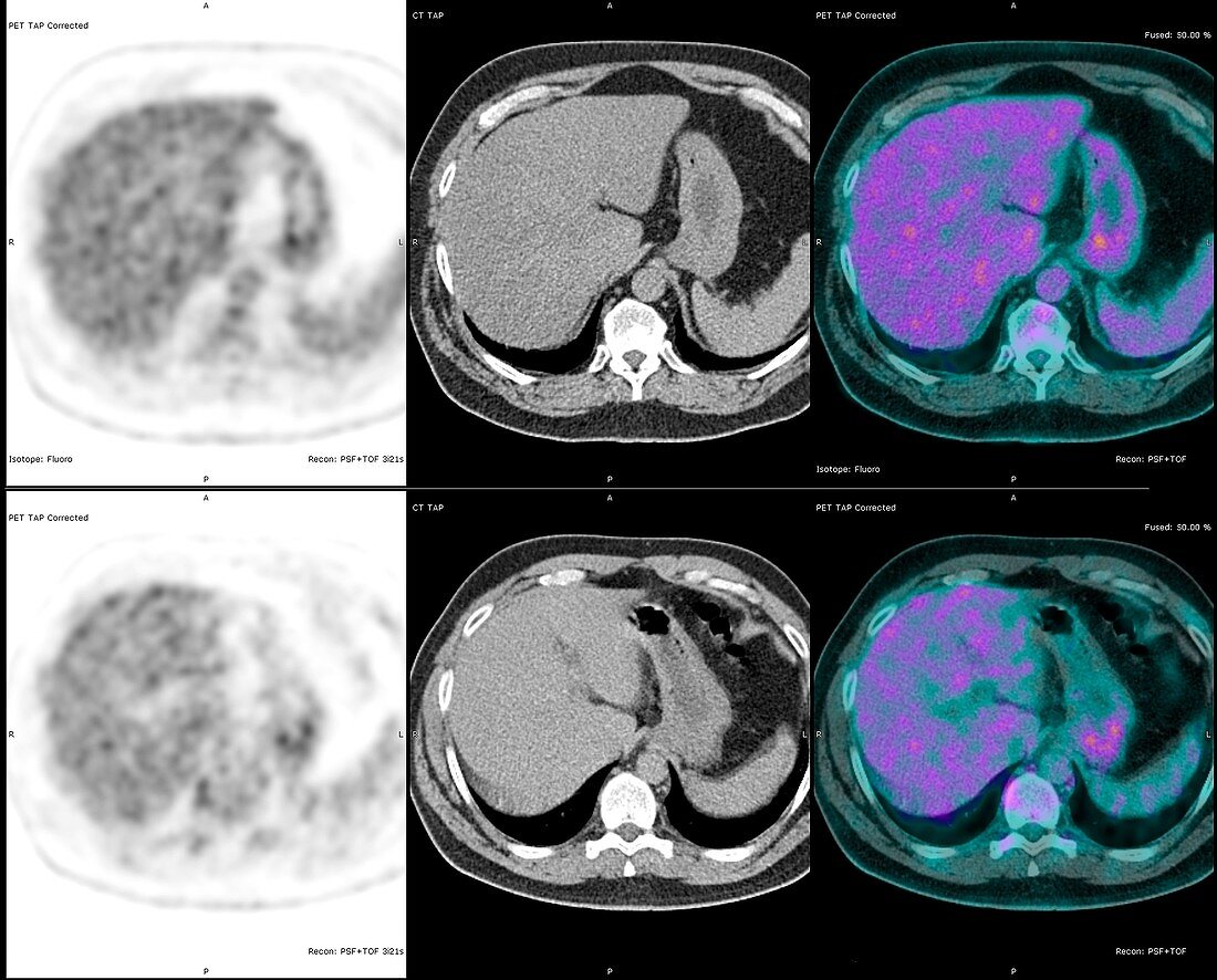 Colon cancer scans, PET and CT scans