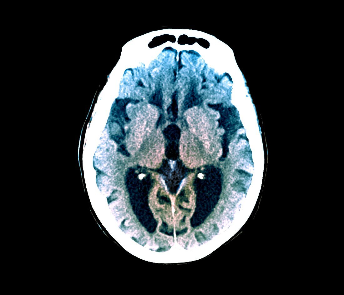 Alzheimer's disease, CT brain scan