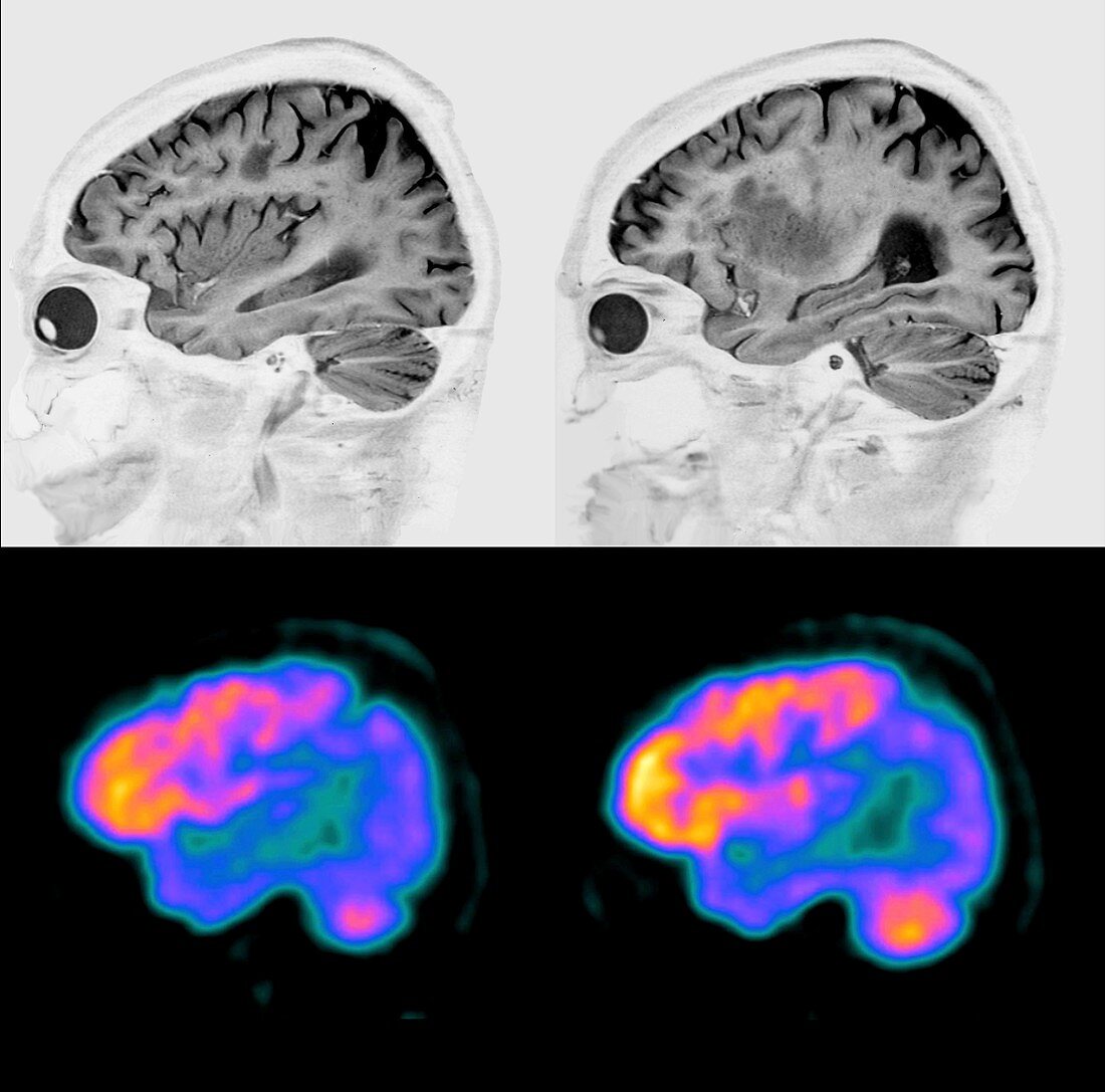 Alzheimer's disease, MRI and PET brain scans