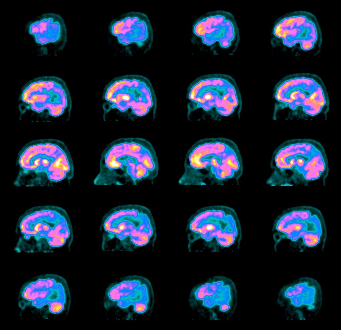 Alzheimer's disease, PET brain scans