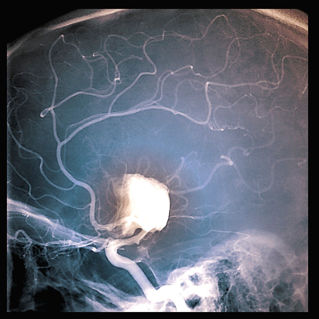 Cerebral aneurysm, angiogram