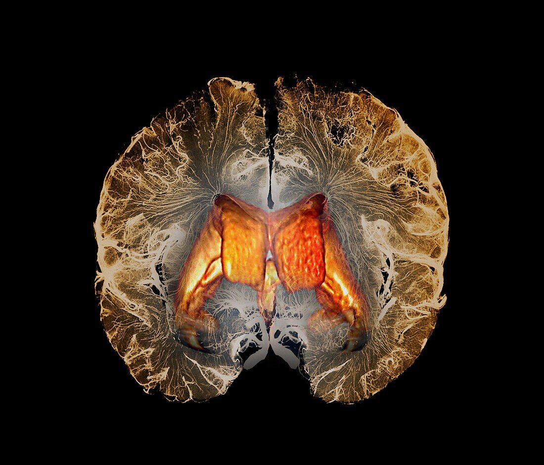 Human brain ventricles, 3D CT scan