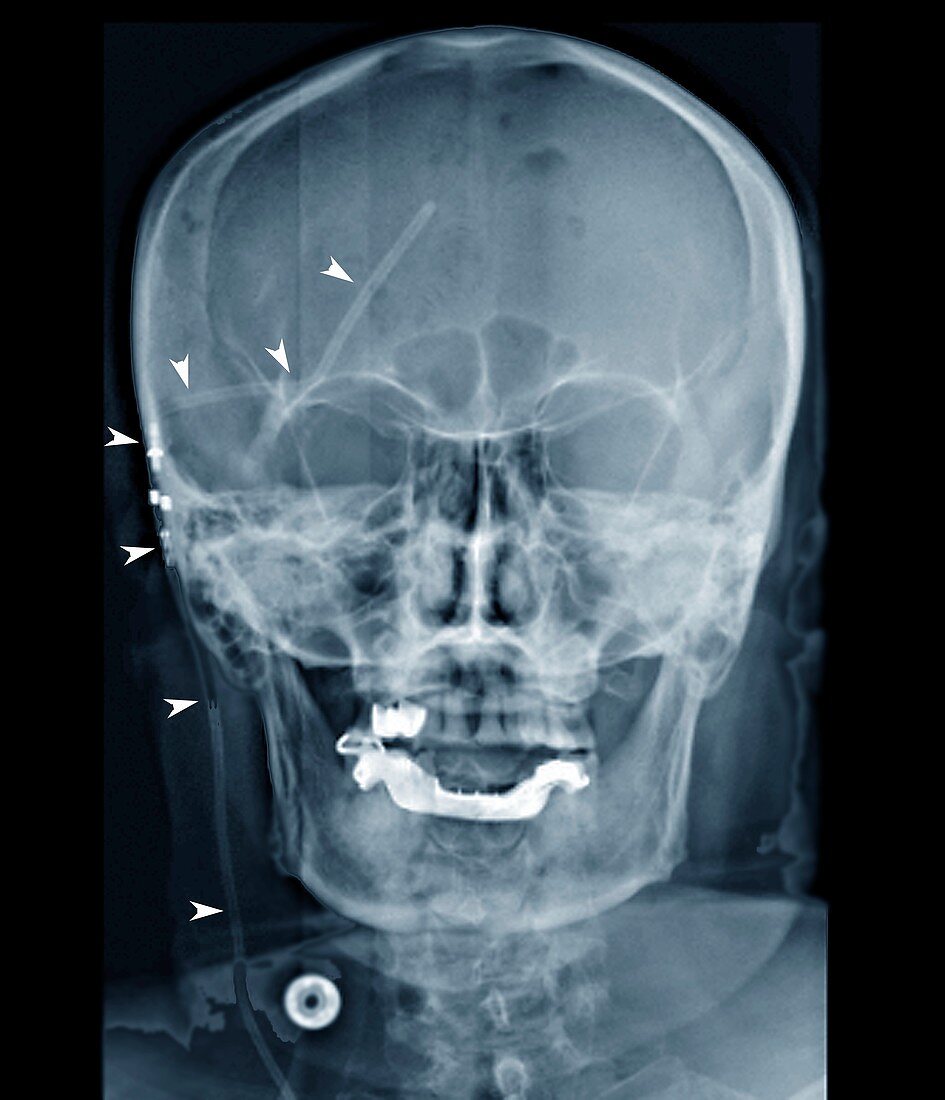 External ventricular drain in neurosurgery, X-ray