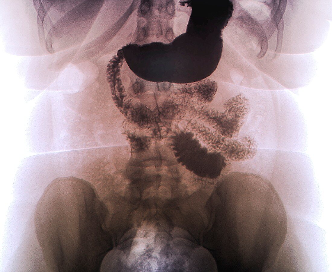 Oeso-gastrointestinal duodenal transit, X-ray