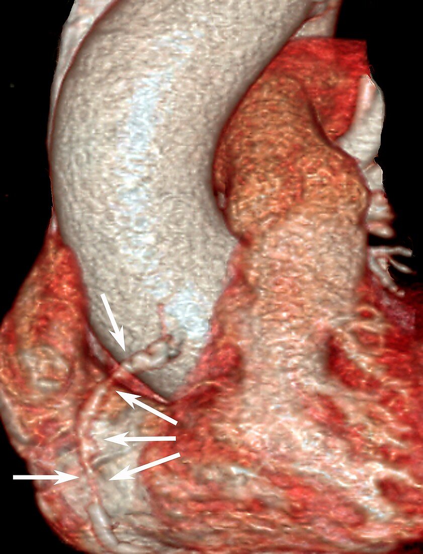 Coronary artery disease, 3D CT angiogram