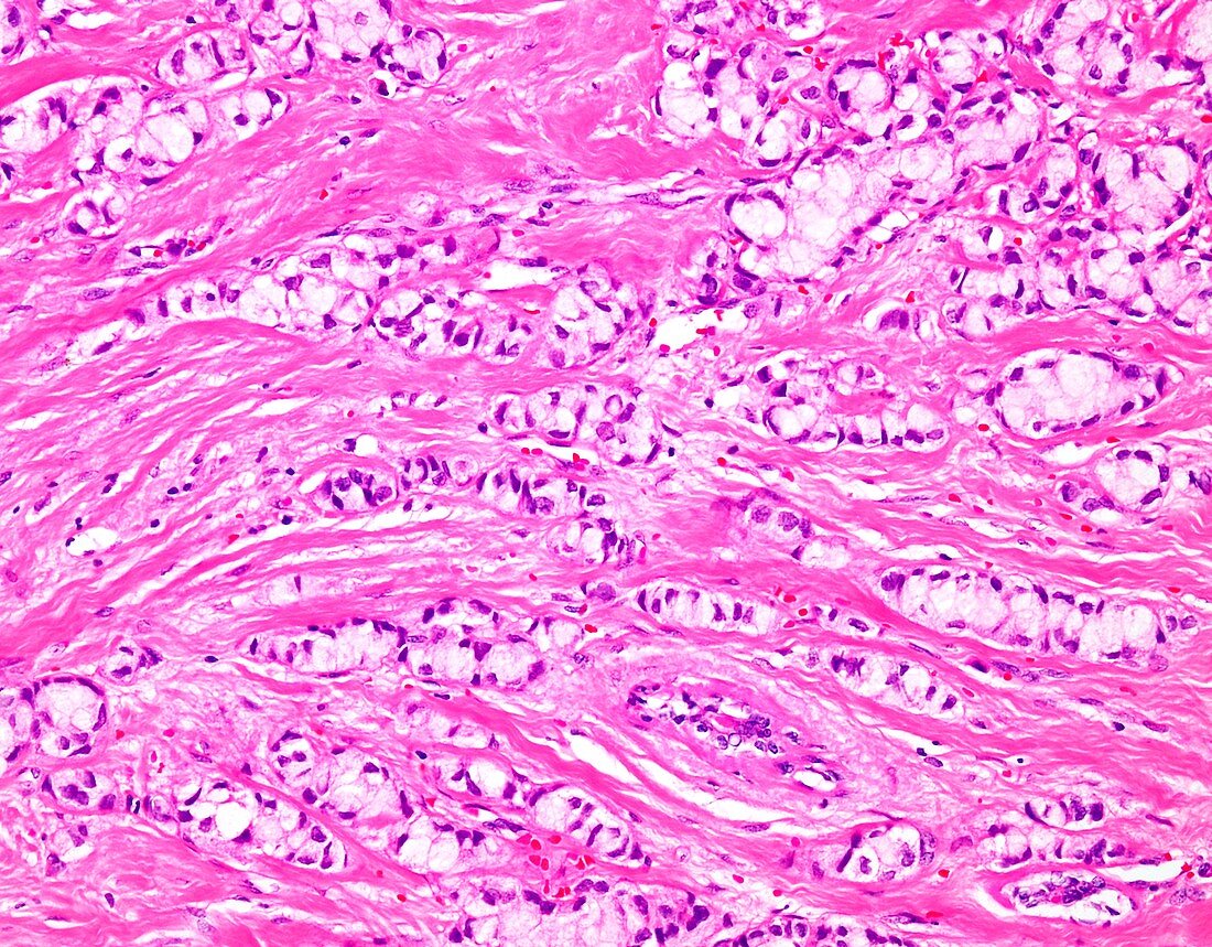 Signet ring lobular breast cancer, light micrograph