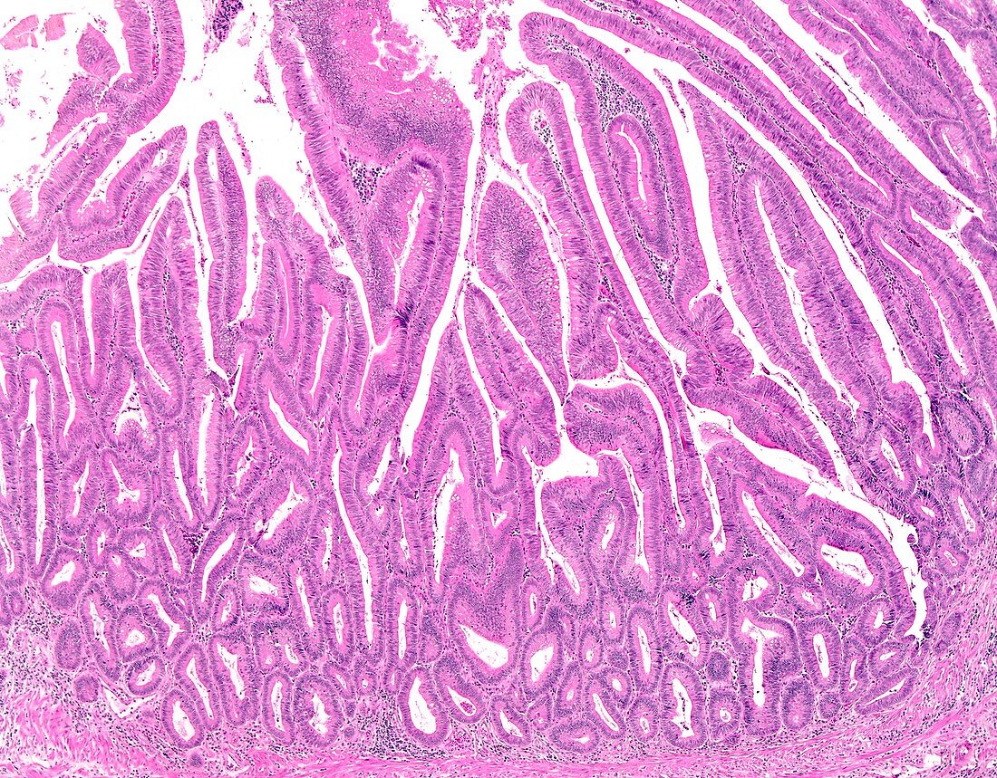 Tubulovillous colon polyp, light micrograph
