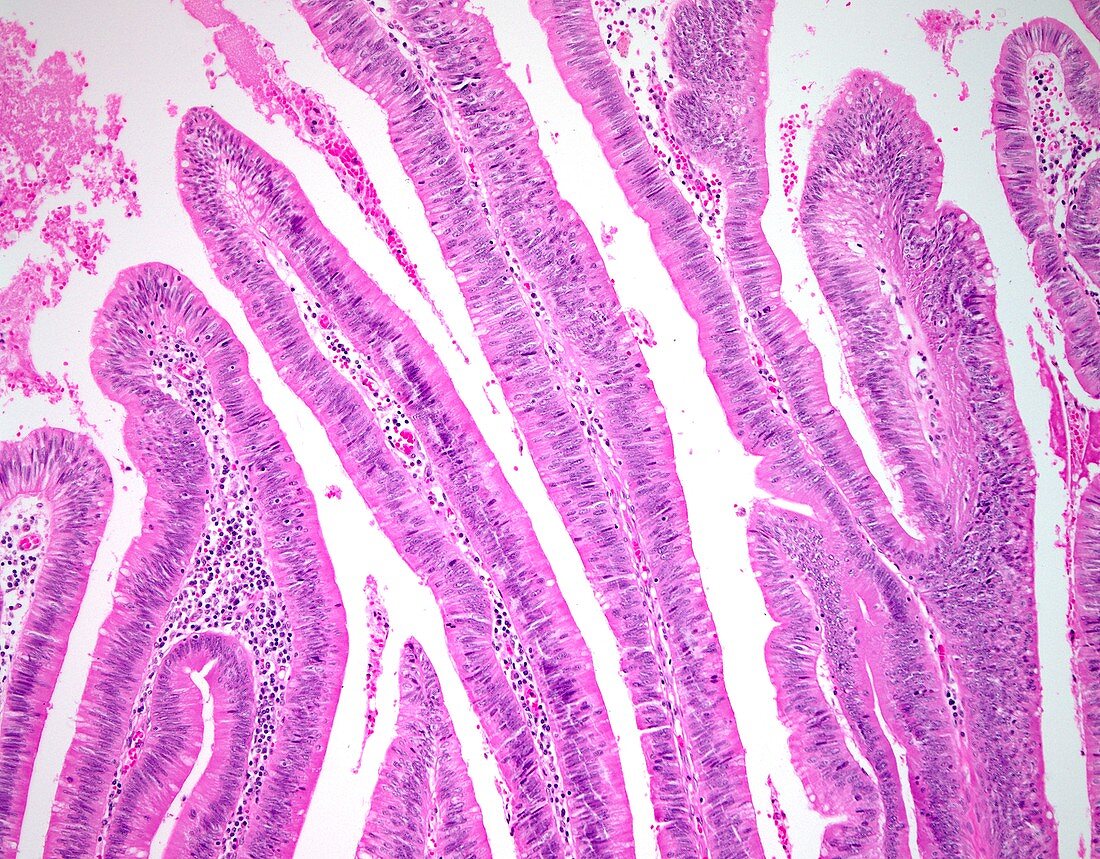 Villous colon polyp, light micrograph