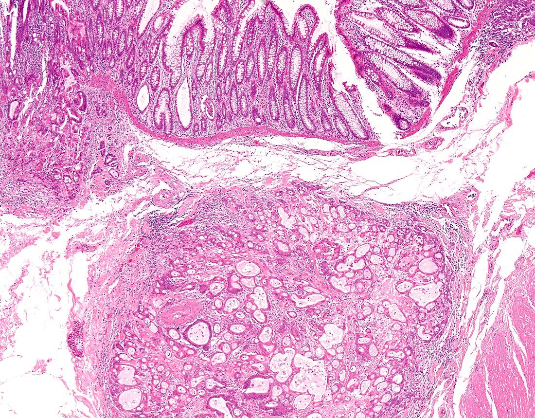 Colon cancer due to genetic mutation, light micrograph