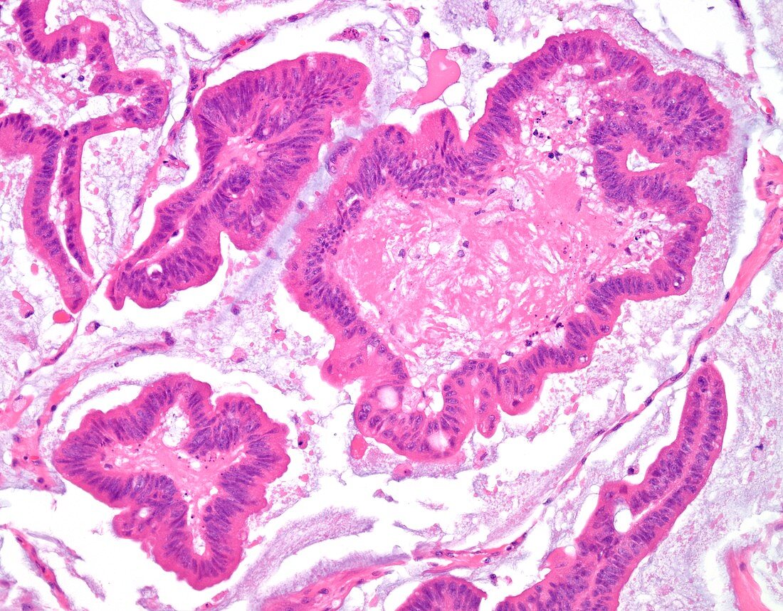 Mucinous carcinoma of the colon, light micrograph