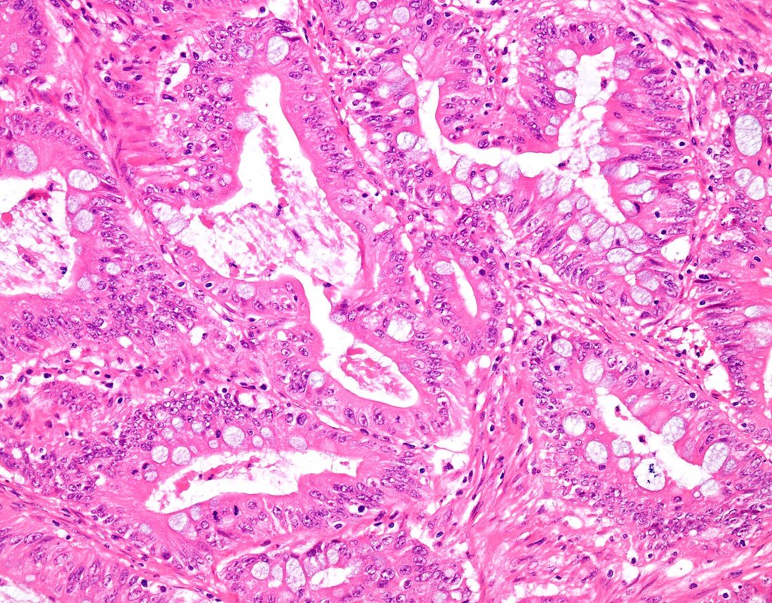 Mucinous carcinoma of the colon, light micrograph