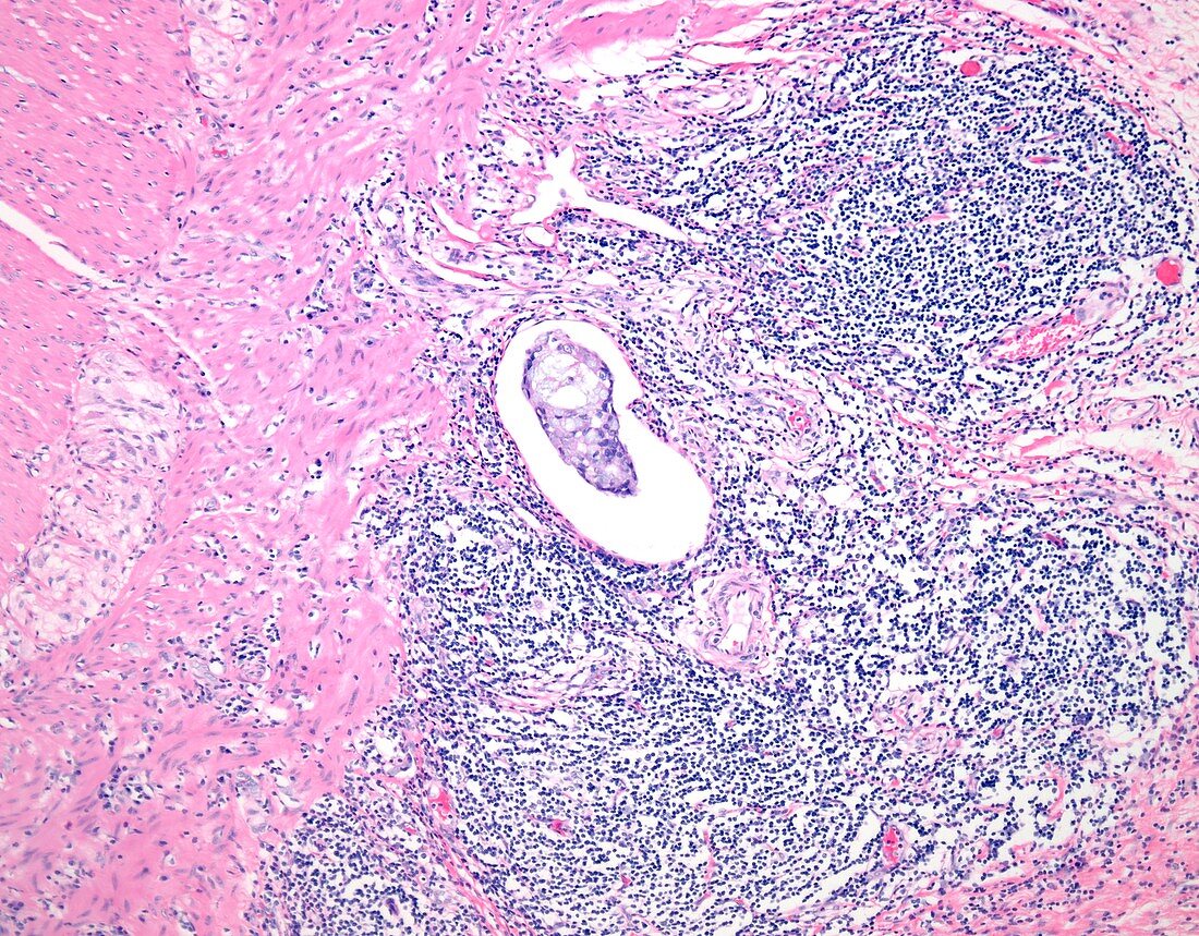 Colon cancer and lymph tissue, light micrograph