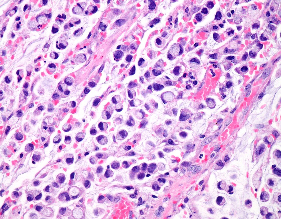 Signet ring cell carcinoma of the colon, light micrograph