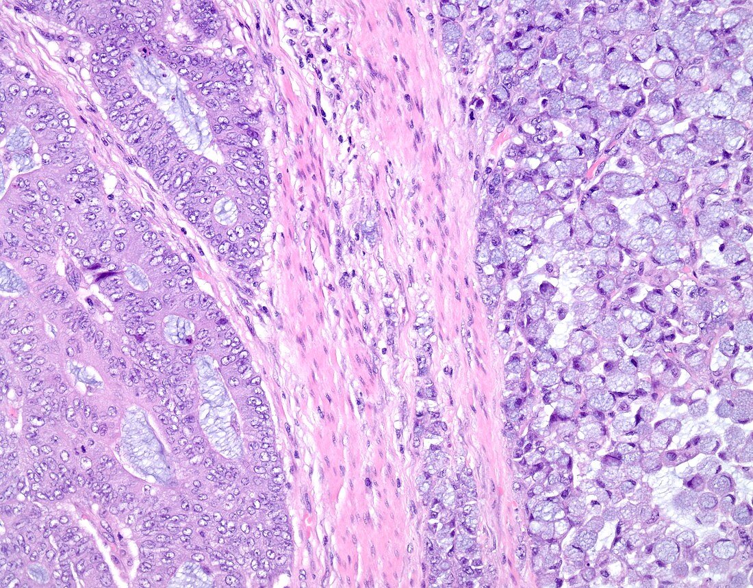 Signet ring cell carcinoma of the colon, light micrograph