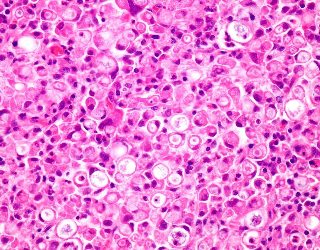 Signet ring cell carcinoma of the colon, light micrograph