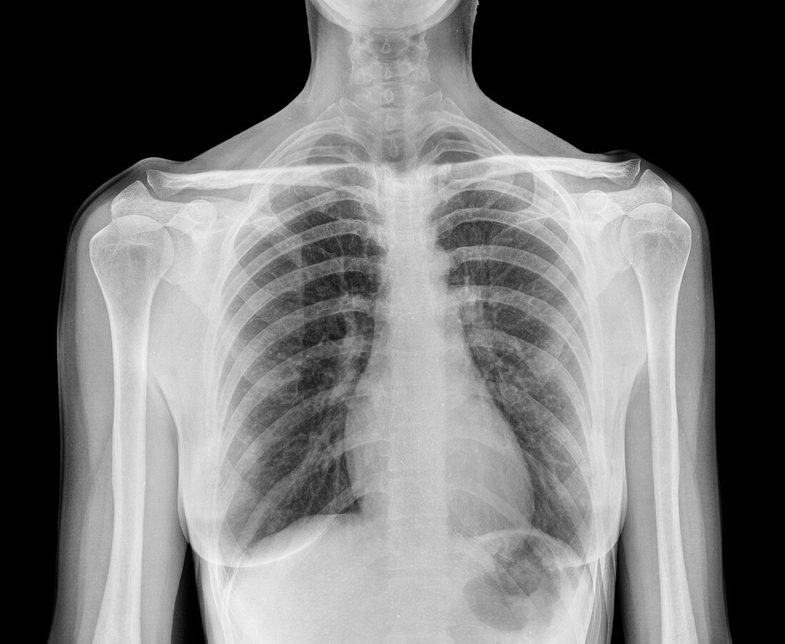 Woman's torso, composite X-ray