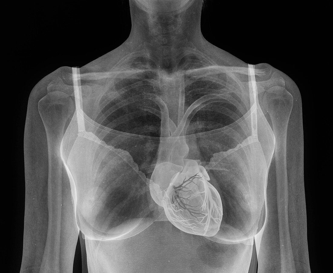 Woman's heart, composite X-ray