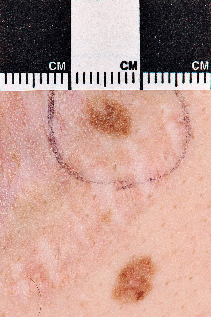 Atypical mole being measured