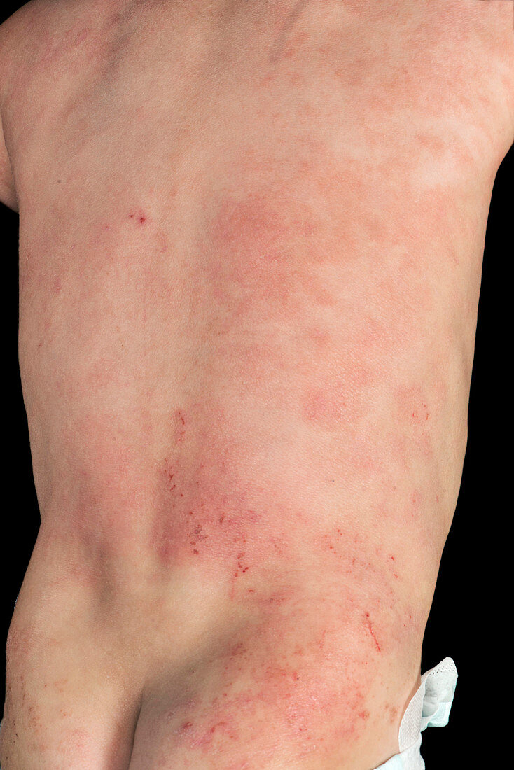 Atopic eczema on a baby's back