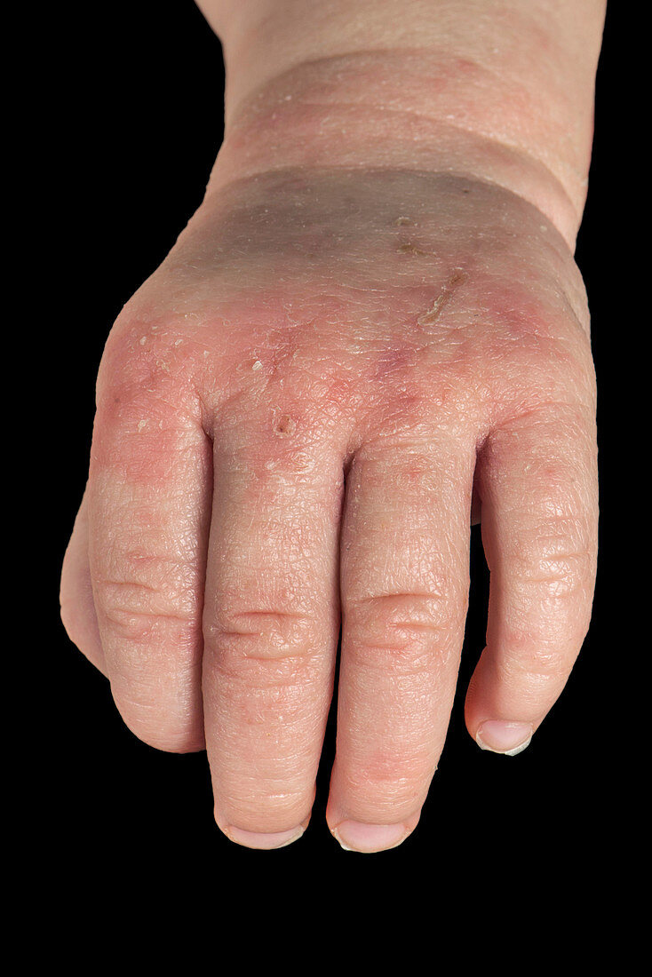 Atopic eczema on a baby's hand