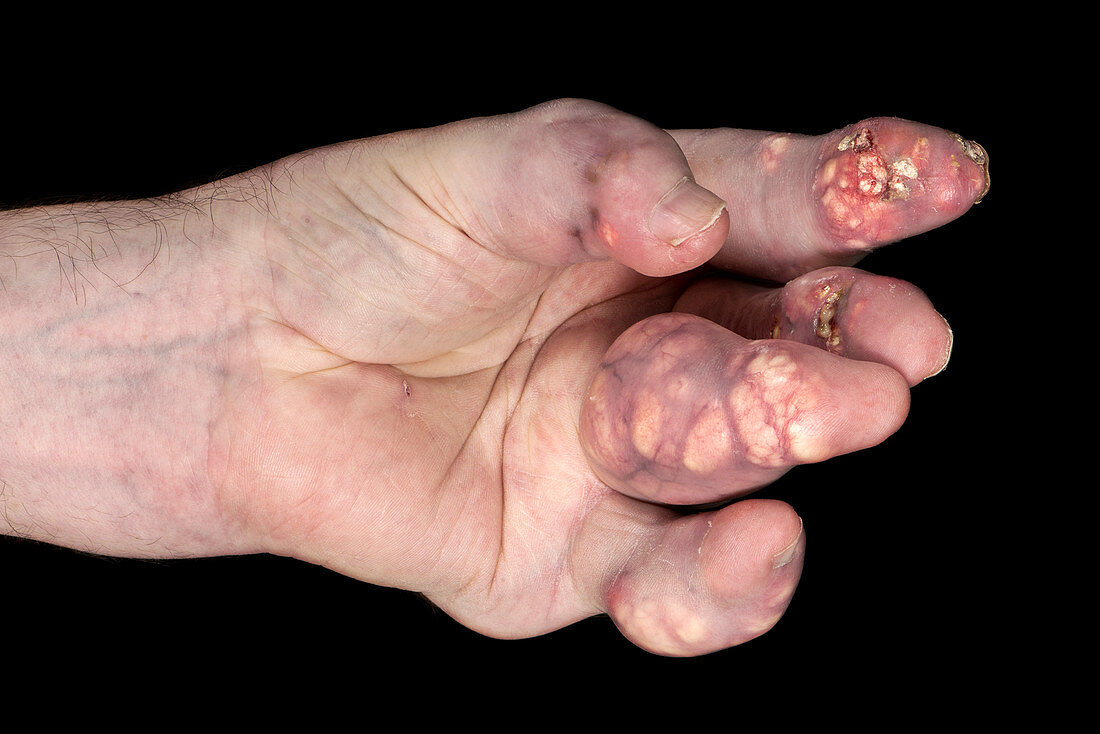 Severe gout affecting the hand