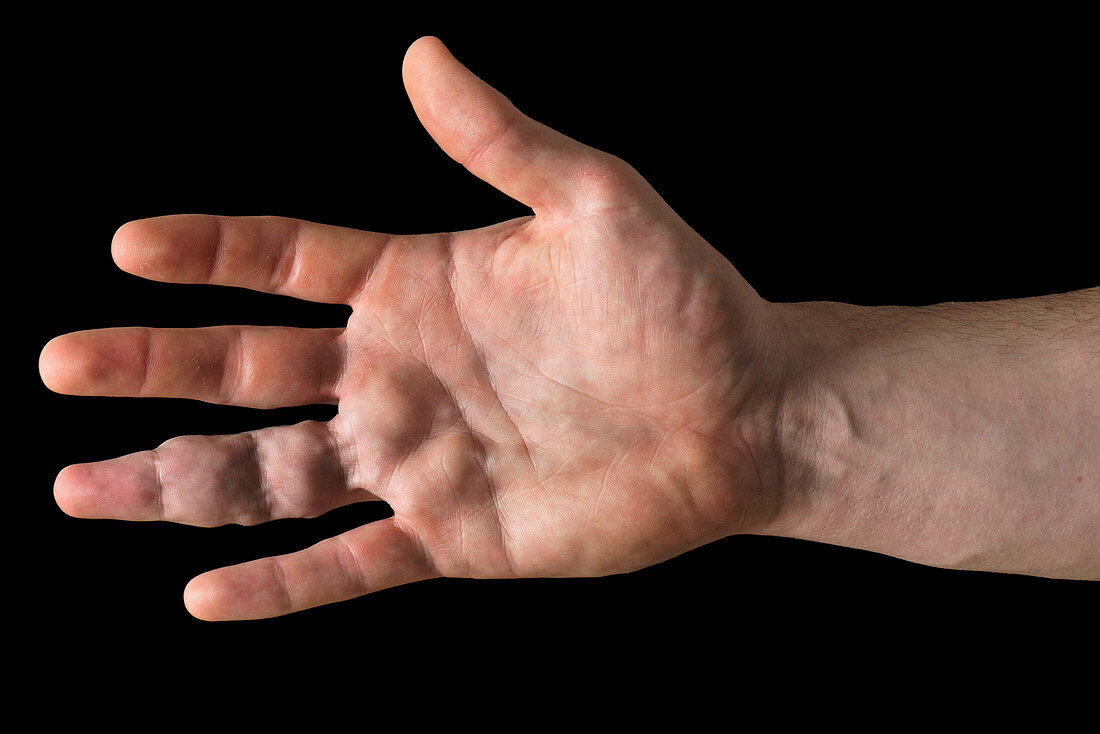 Vascular malformations of the hands