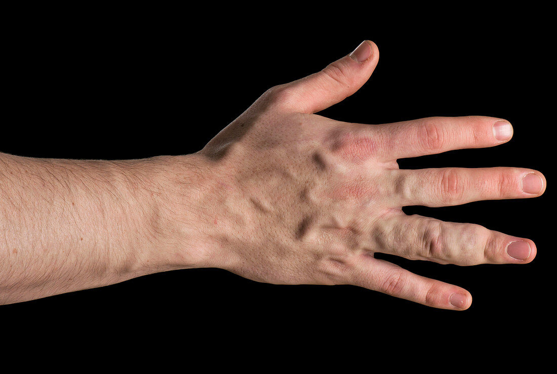 Vascular malformations of the hands
