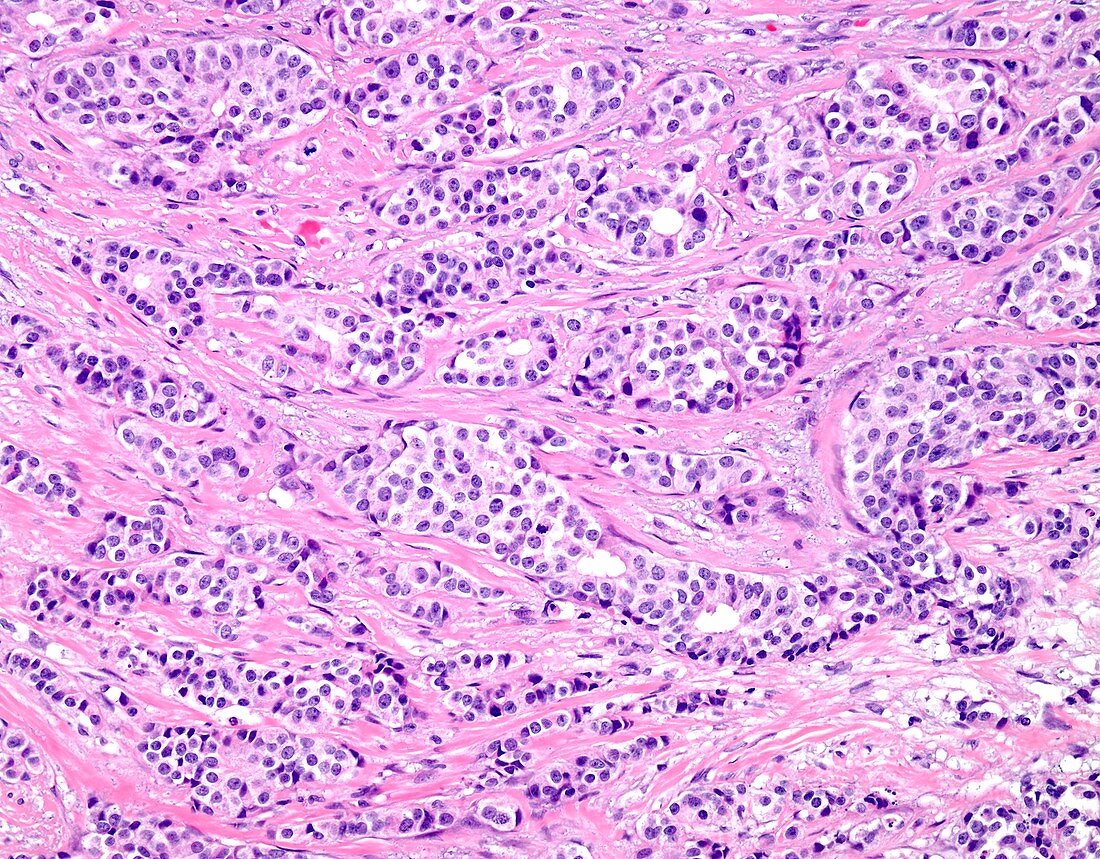 Medium grade invasive ductal breast cancer, light micrograph