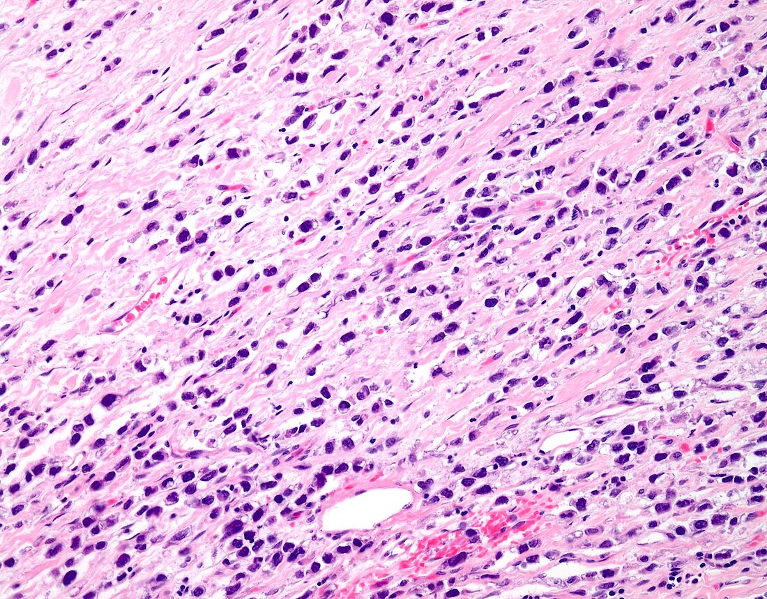 Pleomorphic lobular breast cancer, light micrograph