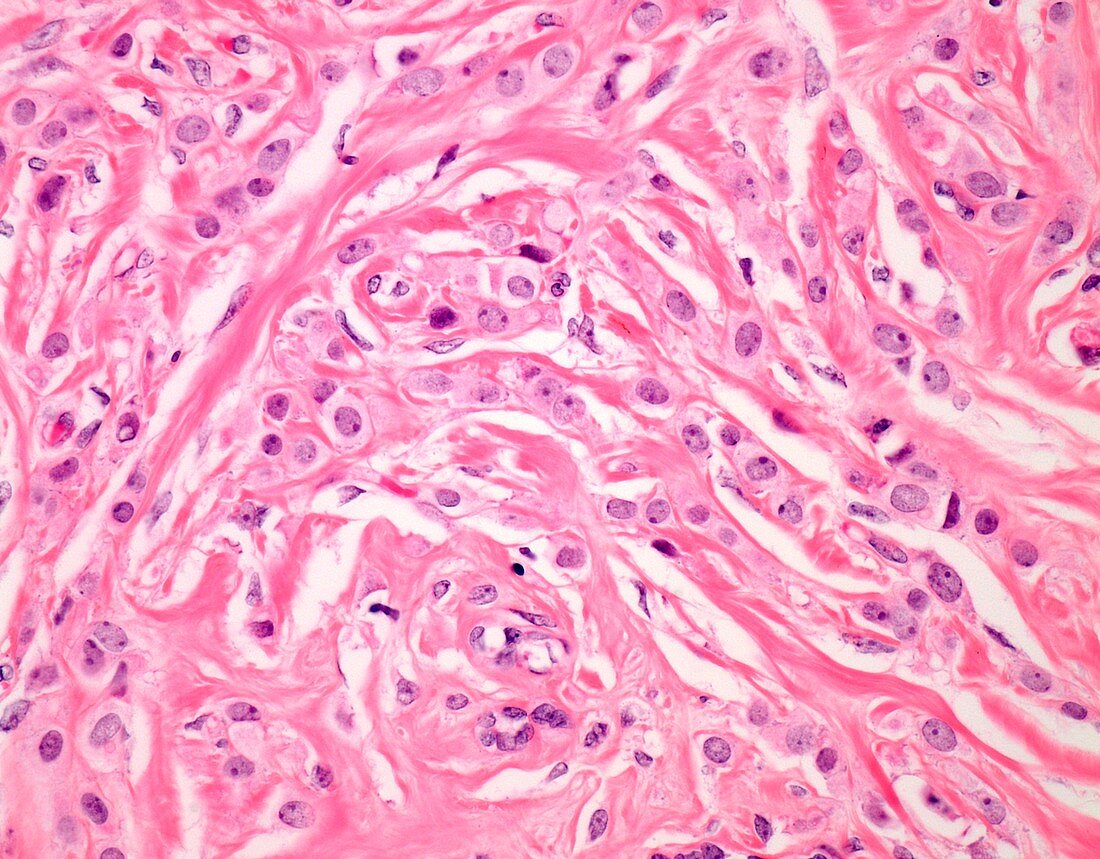 Invasive lobular breast cancer, light micrograph