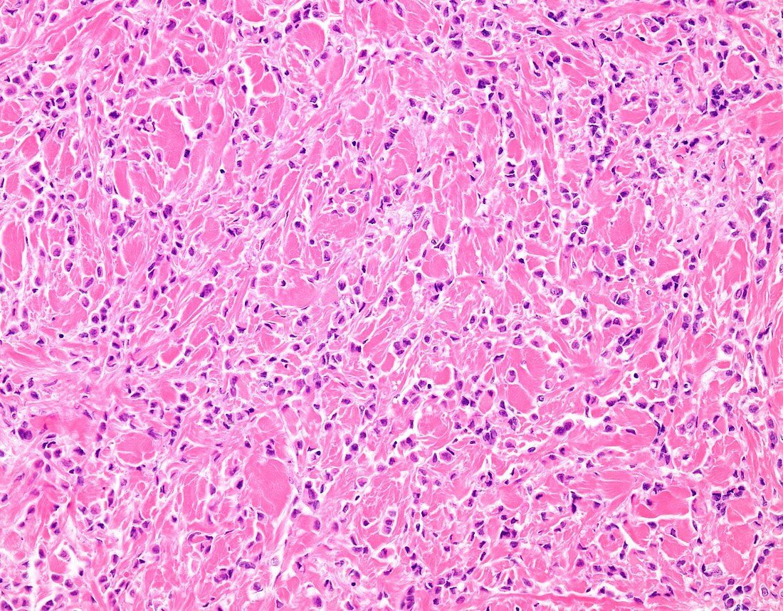 Invasive lobular breast cancer, light micrograph