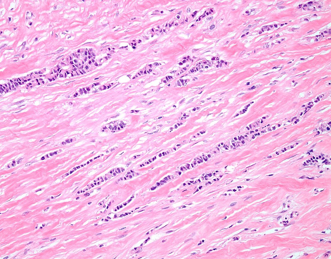 Invasive lobular breast cancer, light micrograph