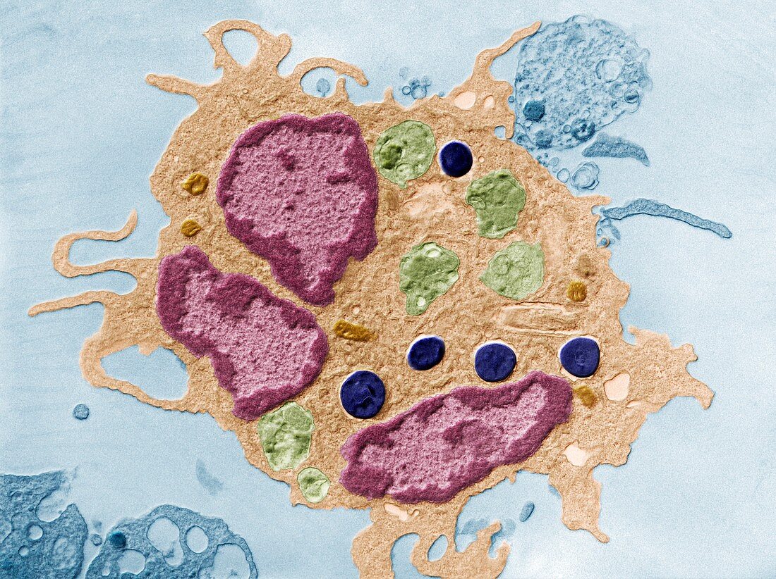 Papillon-Lefevre syndrome cell, TEM